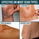 nuvadermis-silicone-scar-sheets-for-surg-5.jpg