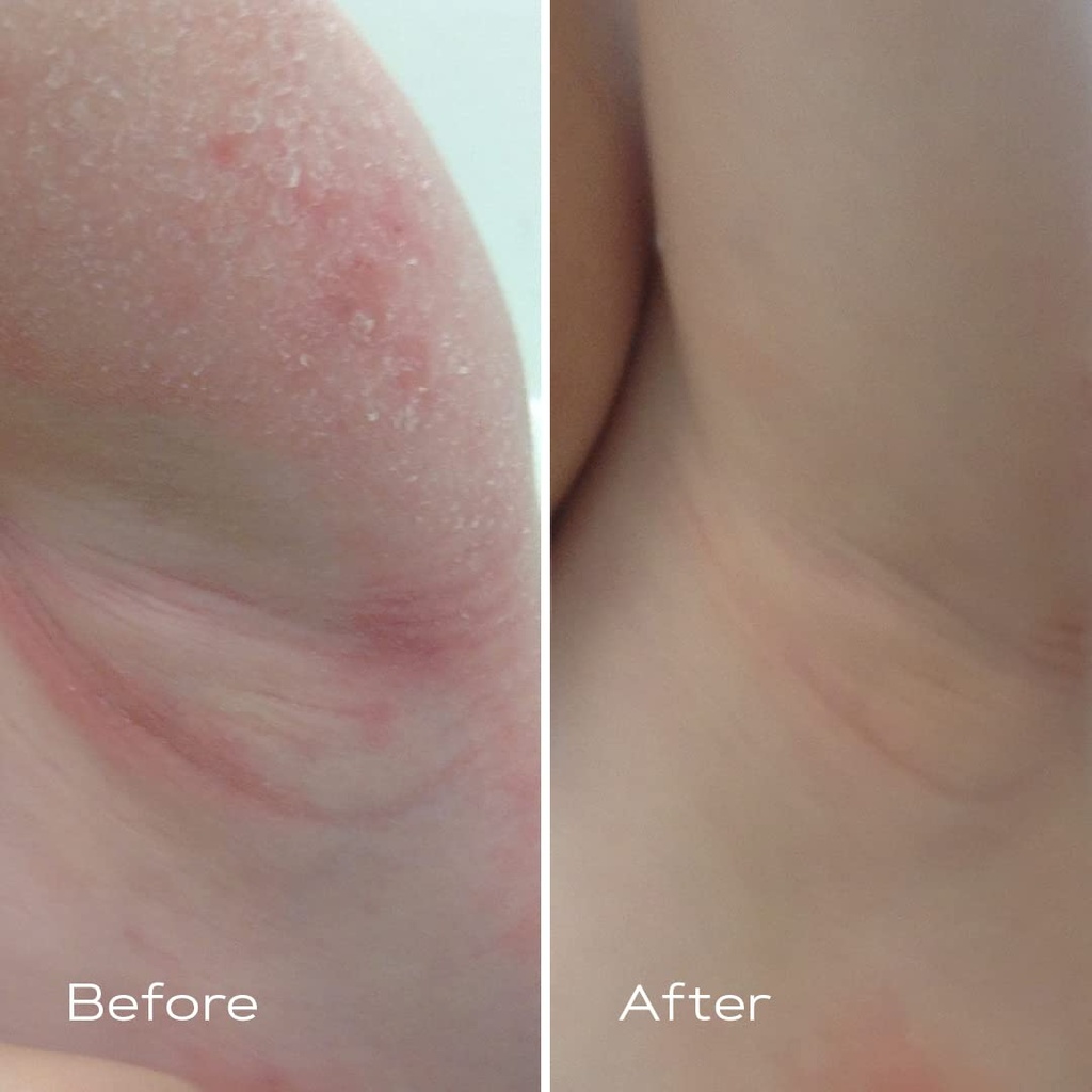 kamedis-eczema-therapy-soothing-body-cre-3.jpg