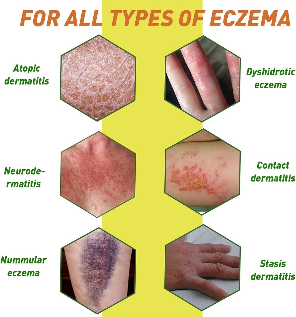 heat-rash-cream-with-organic-manuka-hone-6.jpg
